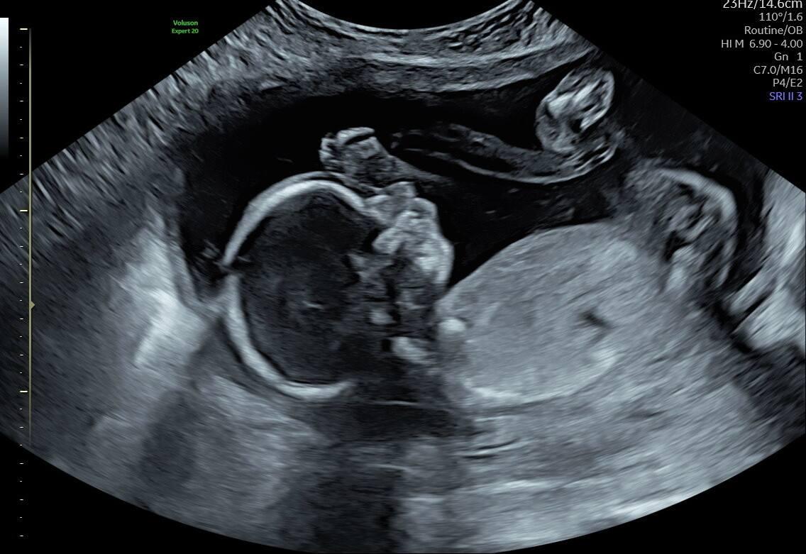 Ultrasound of Trisomy-13 Baby Ezekiel