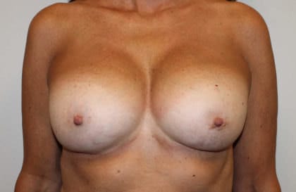 Slender breasts - Post augmentation